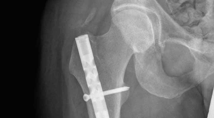 Early hip fracture surgery will save hundreds of lives