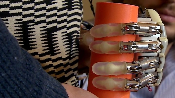 Woman receives bionic hand with sense of touch