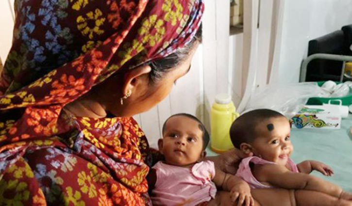 Conjoined twins Tofa, Tahura separated