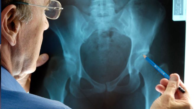 Most hip and knee replacements 'last longer than thought'