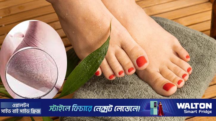 শীতে পা ফাটা রোধে যা যা করতে পারেন