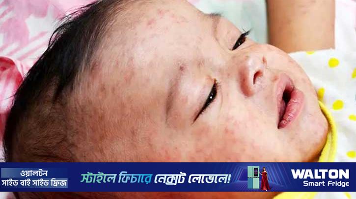 কুষ্টিয়ায় হামের উপসর্গে হাসপাতালে ভর্তি ২৮