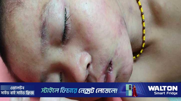 দুর্গম পাহাড়ে হামের সংক্রমণ, ১৯ শিশু হাসপাতালে ভর্তি 