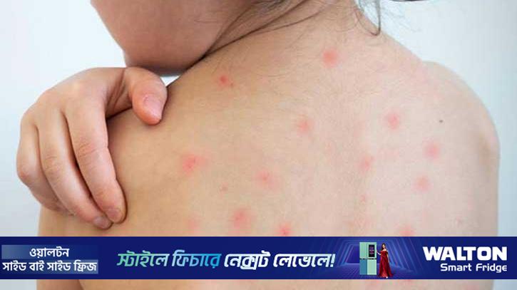 কুষ্টিয়ায় হামের উপসর্গ নিয়ে শিশুর মৃত্যু