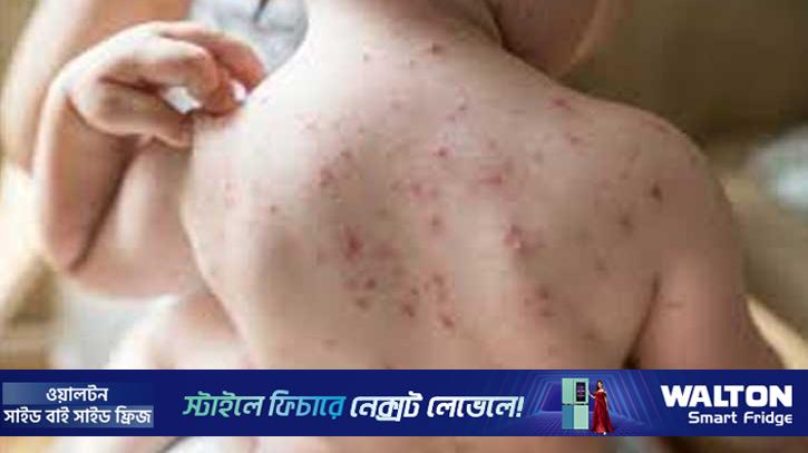 গাজীপুরে একই পরিবারের ৩ শিশু হামে আক্রান্ত