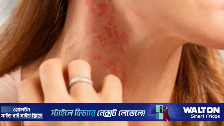 গরমে ত্বকের অ্যালার্জি বাড়ছে?  করণীয় জেনে নিন