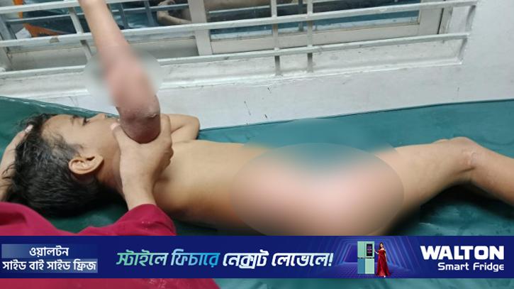 ডিমের দোকানের ফুটন্ত পানিতে দগ্ধ পথশিশু