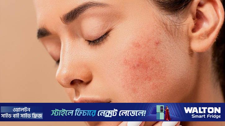 মানসিক চাপ কীভাবে ত্বকের ক্ষতি করে