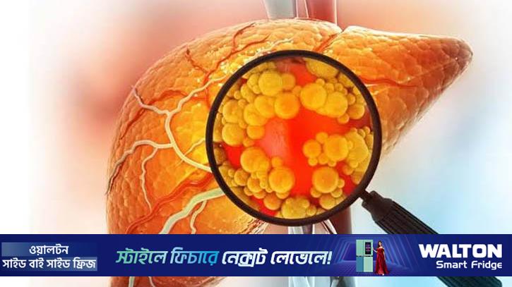 ফ্যাটি লিভার নিয়ন্ত্রণে করণীয়