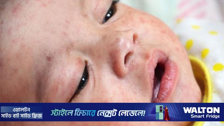 হাম সম্পর্কে যেসব তথ্য জানা জরুরি