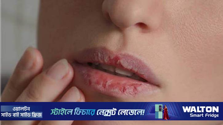 সকালে ঠোঁট-মুখ শুকিয়ে যায়? করণীয় জেনে নিন