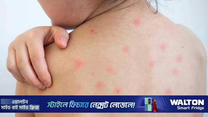 গাজীপুরে হামে আরো এক শিশুর মৃত্যু, হাসপাতালে ভর্তি ৪৭ জন 